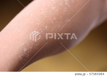 日焼けのあとの皮むけ 57365064