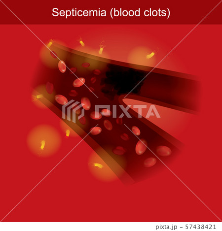 Septicemia infographic 3d Illustration. Septicemia infographic 3d Illustration. 57438421