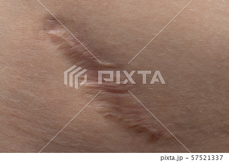 Macro photo of the young human's scar texture 57521337