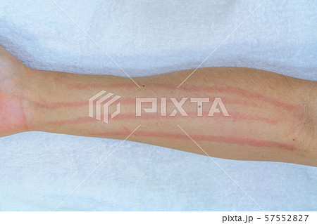 物理性蕁麻疹の写真素材