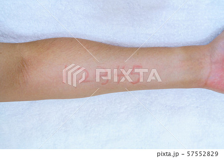 物理性蕁麻疹の写真素材