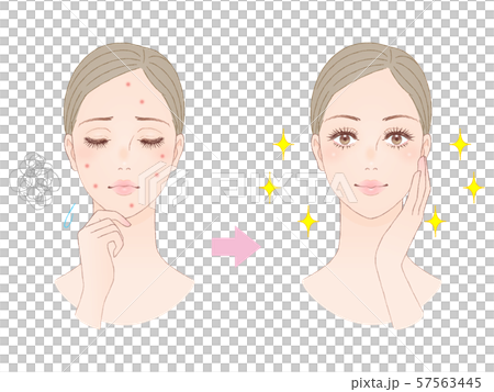 Beauty image acne 57563445