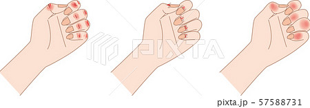 あかぎれ・さかむけ・しもやけ あかぎれ・さかむけ・しもやけ 57588731