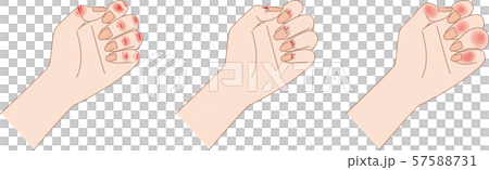 あかぎれ・さかむけ・しもやけ あかぎれ・さかむけ・しもやけ 57588731