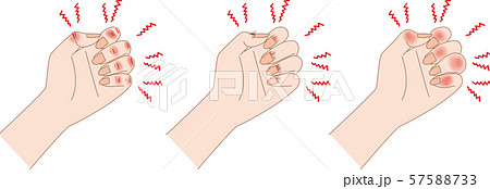 あかぎれ さかむけ しもやけのイラスト素材