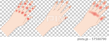 あかぎれ・さかむけ・しもやけ 57588790