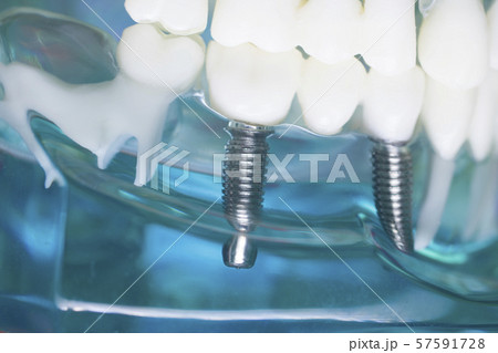 Dentist teeth implant dental model 57591728