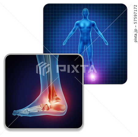 Human Foot Joint Pain Human Foot Joint Pain 57597172