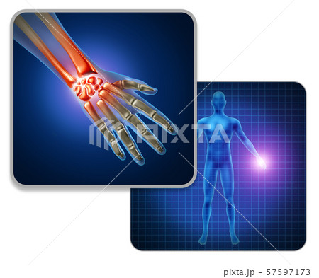 Human Hand Joint Pain 57597173