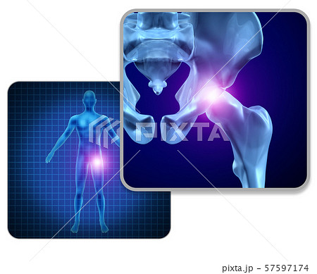 Human Hip Joint Pain 57597174