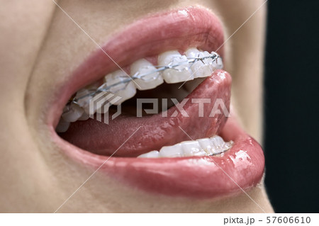 Closeup view at female teeth with bracket system Closeup view at female teeth with bracket system 57606610