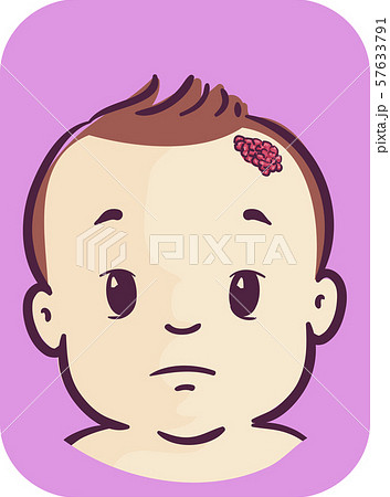 Baby Symptom Strawberry Nevus Illustration 57633791
