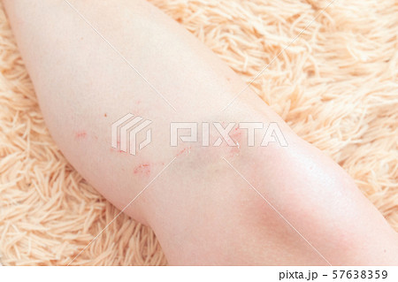 Sport injury and health. Bruised knee. Sport injury and health. Bruised knee. 57638359