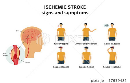 Ischemic stroke signs and symptoms infographic flat vector illustration isolated. 57639485