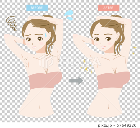 Armpit hair removal before after young woman - Stock Illustration  [57649220] - PIXTA
