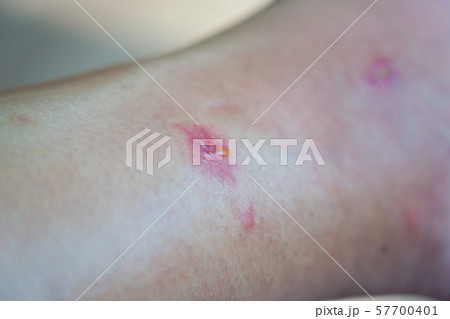 虫刺され 57700401