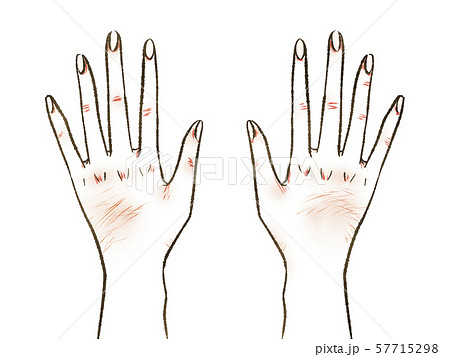 女性の手 手荒れ 手湿疹のイラスト素材