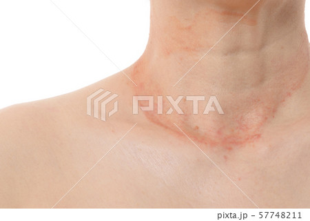 皮膚病の女性 57748211