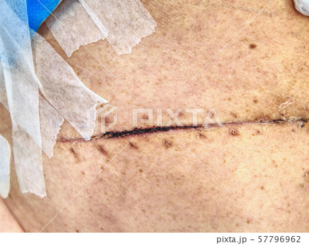 Bandage of fresh scar on the abdomen and side of Bandage of fresh scar on the abdomen and side of 57796962
