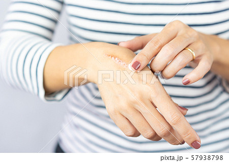 A woman applying scars removal cream to heal the first degree - heat burn wound on her hand. Healing, Removal, treatment, Hot oil burn, Vitamin E, Scars care, Skin care products, Medical cream, Repair A woman applying scars removal cream to heal the first degree - heat burn wound on her hand. Healing, Removal, treatment, Hot oil burn, Vitamin E, Scars care, Skin care products, Medical cream, Repair 57938798