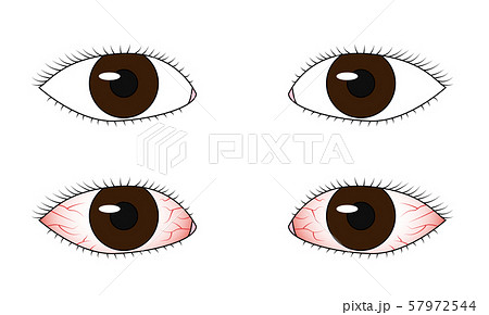 健康な目と充血した目のイラスト素材