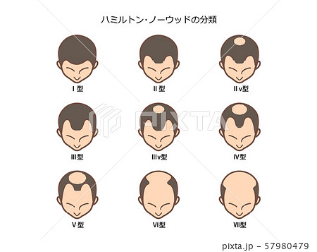 男性型脱毛症の分類 題付きハミルトン ノーウッド分類のイラスト素材