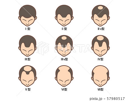 男性型脱毛症の分類 男性型脱毛症の分類 57980517