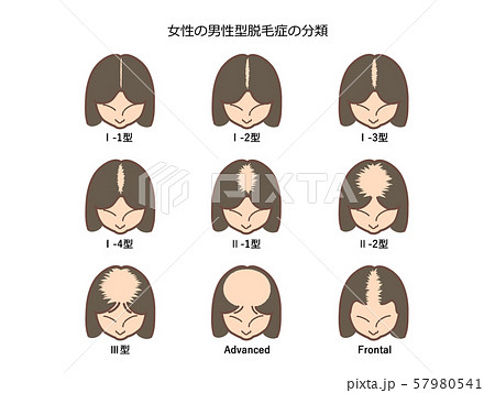女性の男性型脱毛症の分類1　題付き 57980541
