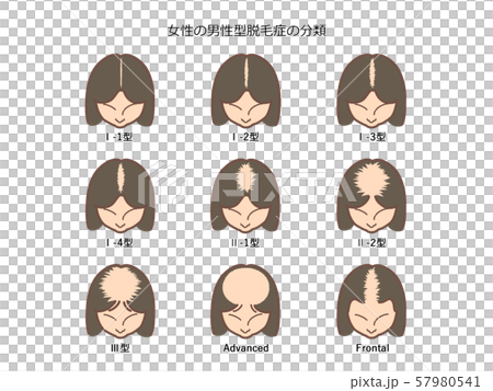 女性の男性型脱毛症の分類1　題付き 57980541