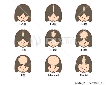 女性の男性型脱毛症の分類1 57980542
