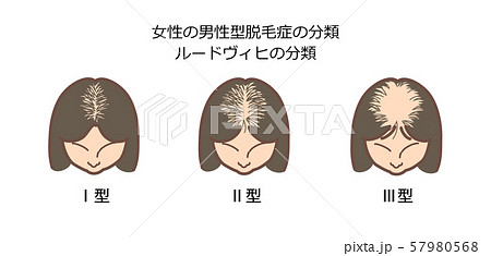女性の男性型脱毛症の分類2　題付き2種 57980568