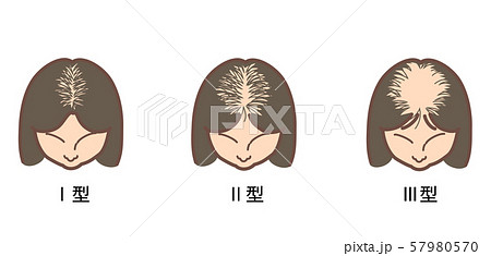 女性の男性型脱毛症の分類2 57980570