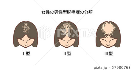 女性の男性型脱毛症の分類2 題付き 女性の男性型脱毛症の分類2 題付き 57980763