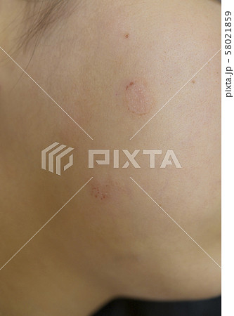 皮膚病（ぜにたむし 体部白癬） 58021859
