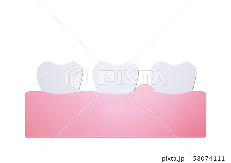 periodontitis or gum disease with swell (swollen on gum and tooth because inflammation) 58074111