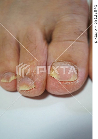 爪 白癬 菌 治りにくい爪の水虫「爪白癬」と進化する治療法 [皮膚・爪・髪の病気]