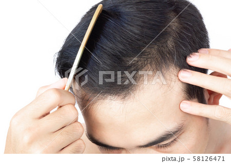 Young man serious hair loss problem for health 58126471