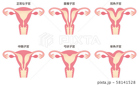 子宮奇形 子宮奇形 58141528
