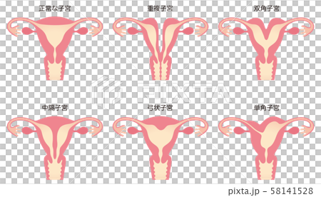 子宮畸形 子宮畸形 58141528