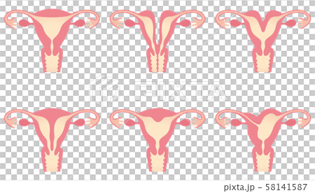 Uterine malformation 58141587