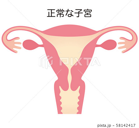 子宮奇形 子宮奇形 58142417