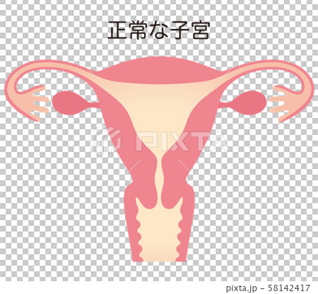 子宮畸形 子宮畸形 58142417