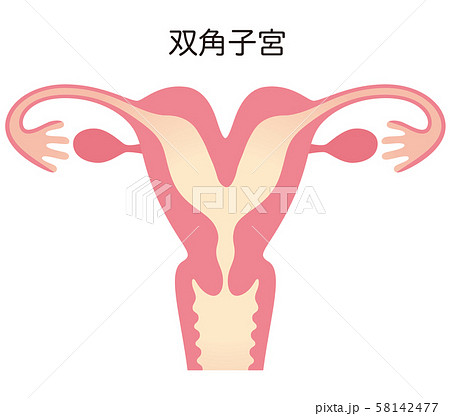 子宮奇形 双角子宮 子宮奇形 双角子宮 58142477