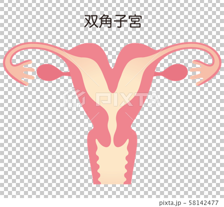 子宮畸形 子宮畸形 58142477