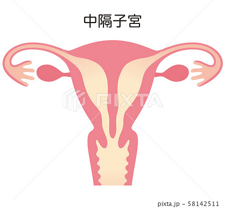 子宮奇形　中隔子宮 58142511