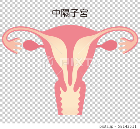 子宮畸形子宮中隔 子宮畸形子宮中隔 58142511