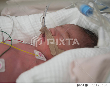 NICUで呼吸器をつけた赤ちゃん 58170608