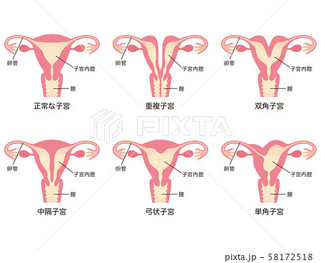 子宮奇形 58172518