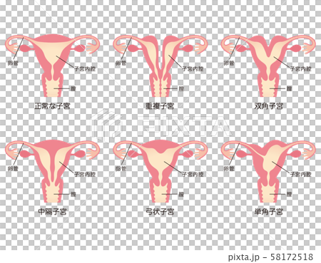 子宮畸形 子宮畸形 58172518