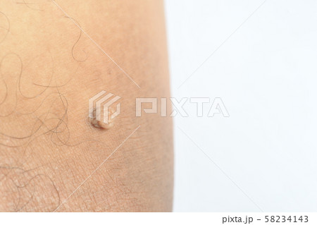 Pedunculated Mass skin tag or acrochondon or soft Pedunculated Mass skin tag or acrochondon or soft 58234143